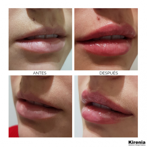 Relleno de labios